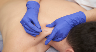 dry needling Melbourne