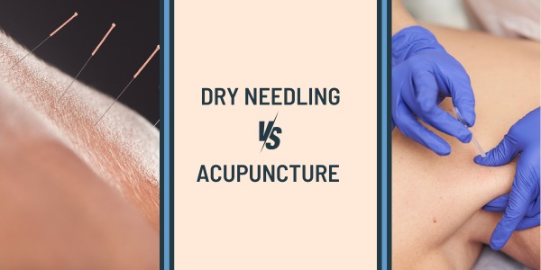 Dry needling vs Acupuncture